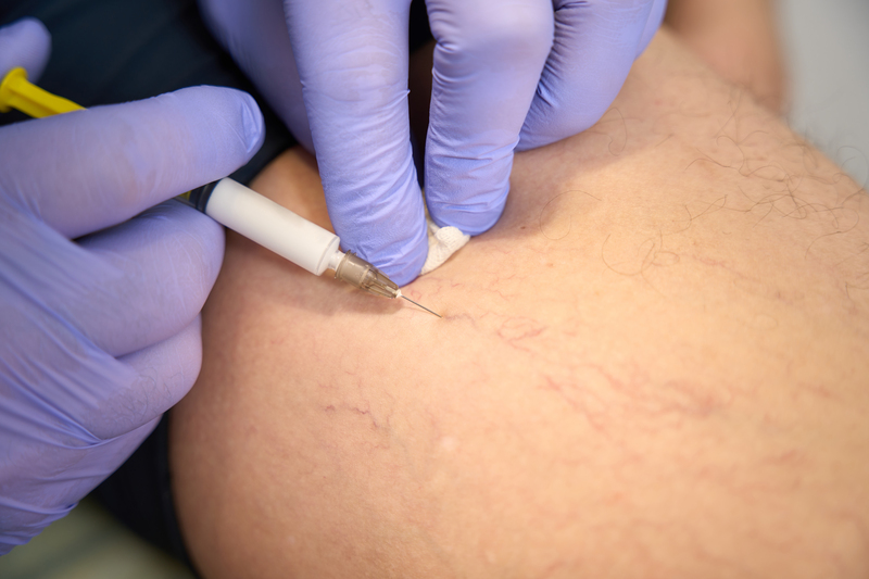 Sclerotherapy: A treatment for Spider Veins